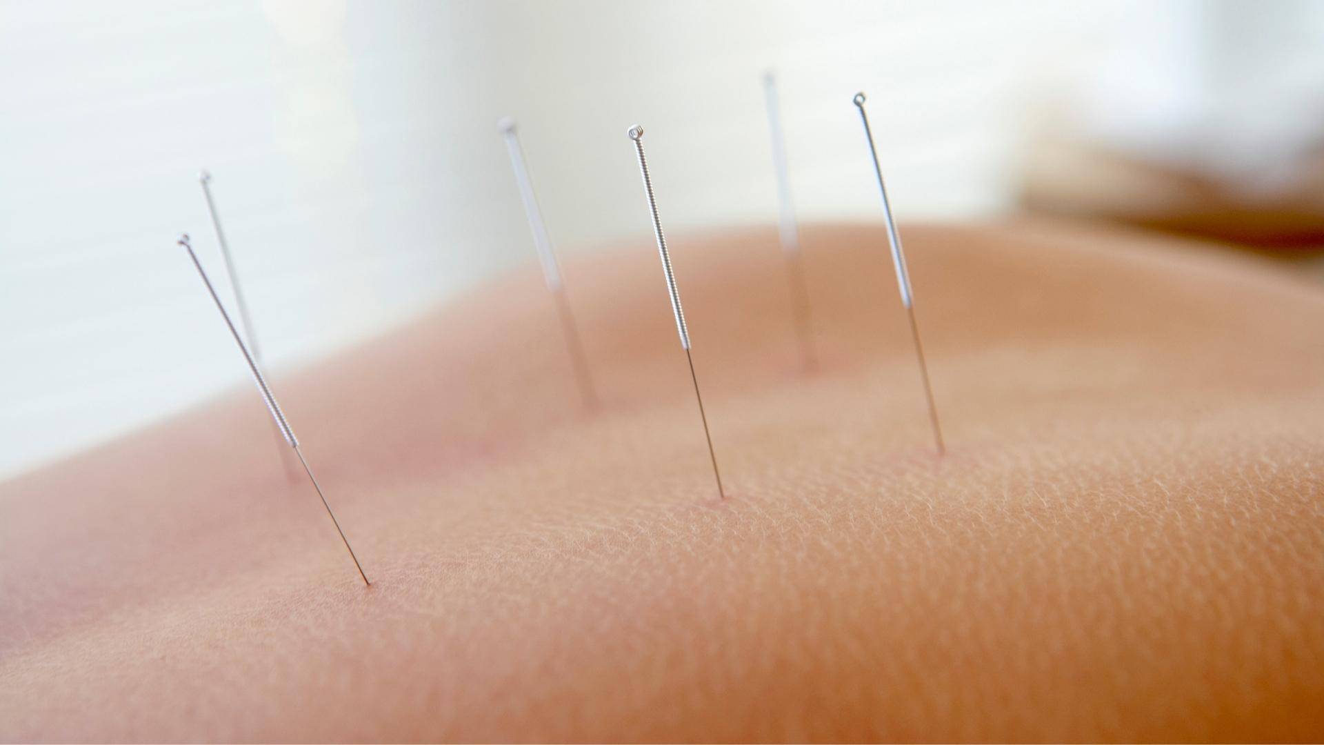 How Does Acupuncture Work